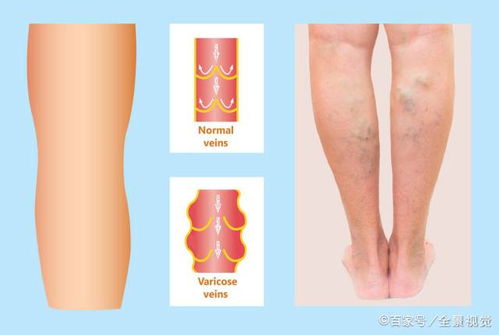 血不通,氣則不順 血管堵塞時,多有這4個癥狀,占一個也要檢查 身體
